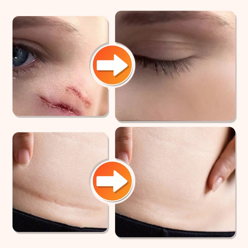 💦✨ Reusable waterproof silicone scar patch! Making scars invisible is not a dream ✨💦! – Bild 2